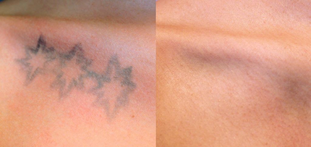 Laser Picosecond Remove Tatto 5 x 20 m